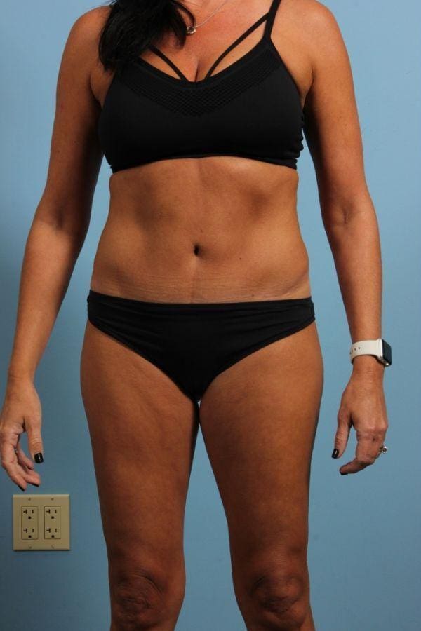 CoolSculpting Patient Photo - Case 13827 - before view-