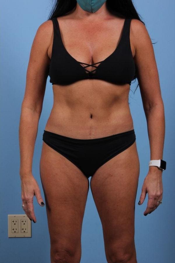 CoolSculpting Patient Photo - Case 13827 - after view
