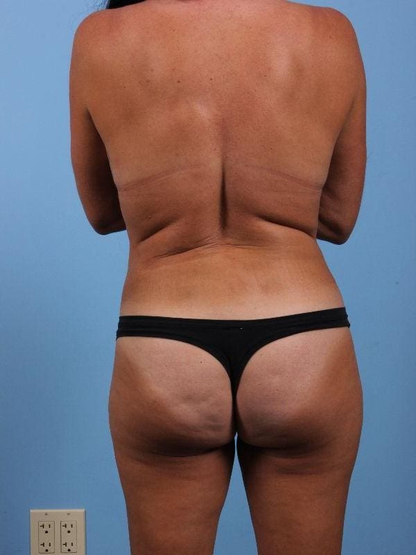 CoolSculpting Patient Photo - Case 13827 - after view-1