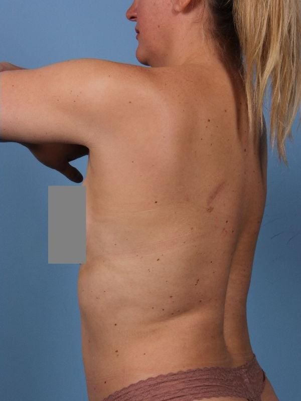 CoolSculpting Patient Photo - Case 13834 - after view-1