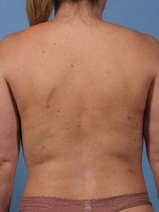 CoolSculpting - Case 13834 - After