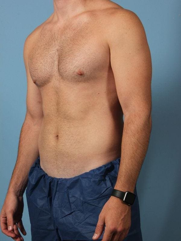 CoolSculpting Patient Photo - Case 13843 - after view-3