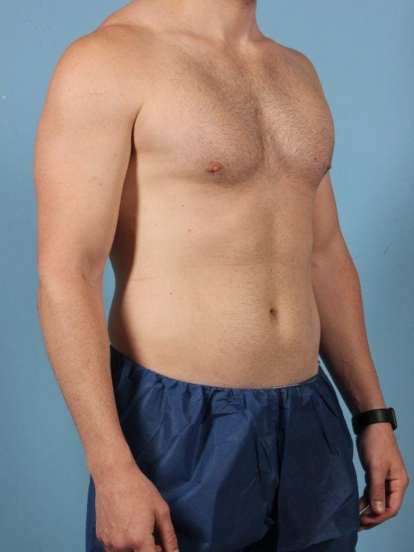 CoolSculpting Patient Photo - Case 13843 - before view-4