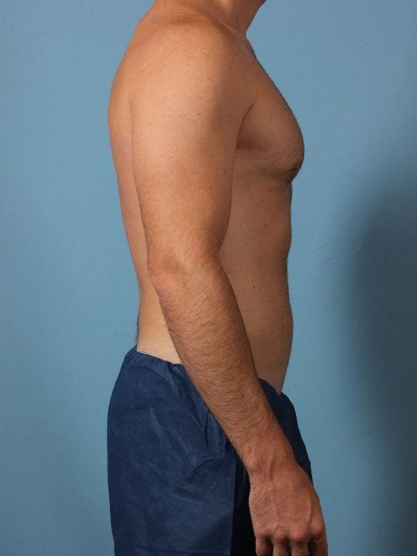 CoolSculpting Patient Photo - Case 13843 - after view-2