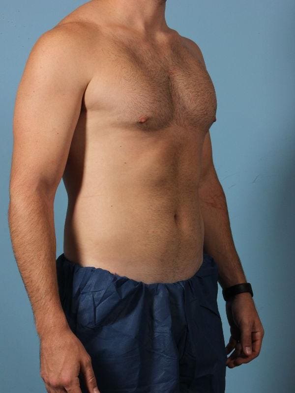 CoolSculpting Patient Photo - Case 13843 - after view-4
