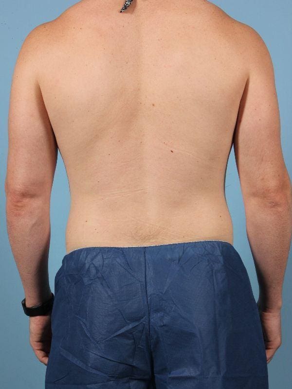 CoolSculpting Patient Photo - Case 13843 - before view-5