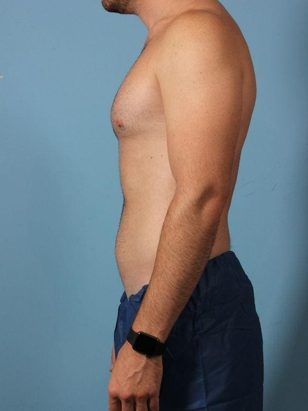 CoolSculpting Patient Photo - Case 13843 - after view-1
