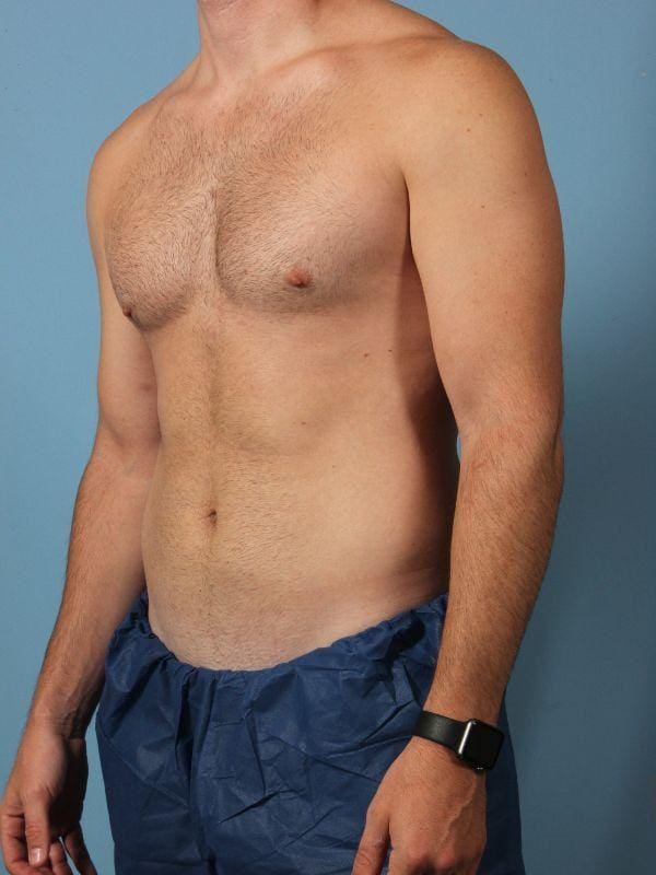 CoolSculpting Patient Photo - Case 13843 - before view-3