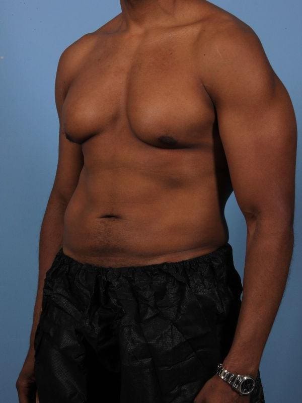 CoolSculpting Patient Photo - Case 13858 - after view-3