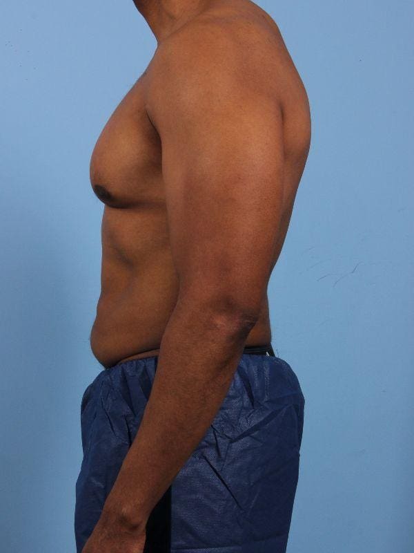 CoolSculpting Patient Photo - Case 13858 - before view-1