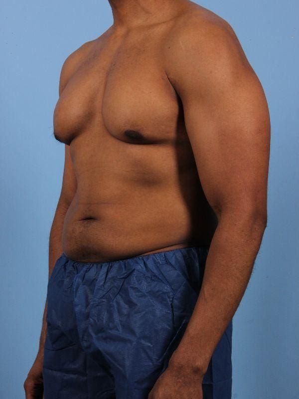 CoolSculpting Patient Photo - Case 13858 - before view-3