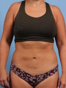 CoolSculpting - Case 13877 - After