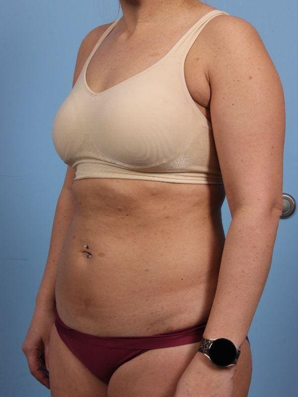 CoolSculpting Patient Photo - Case 13877 - before view-3