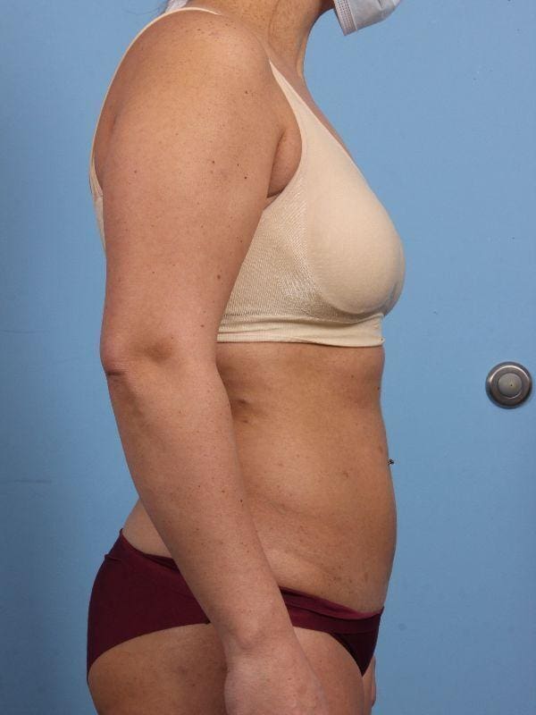 CoolSculpting Patient Photo - Case 13877 - before view-2