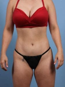 CoolSculpting - Case 13889 - After
