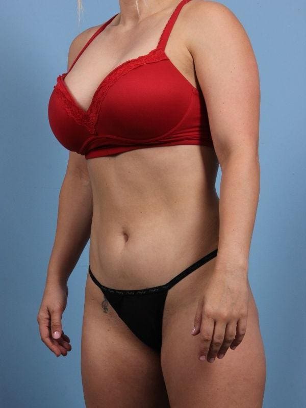 CoolSculpting Patient Photo - Case 13889 - after view-2
