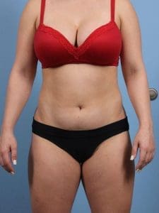 CoolSculpting - Case 13889 - Before