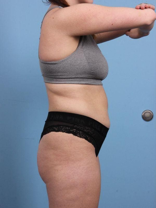 CoolSculpting Patient Photo - Case 13899 - before view-2