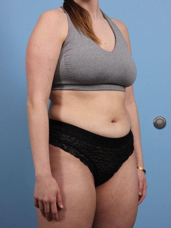 CoolSculpting Patient Photo - Case 13899 - before view-4