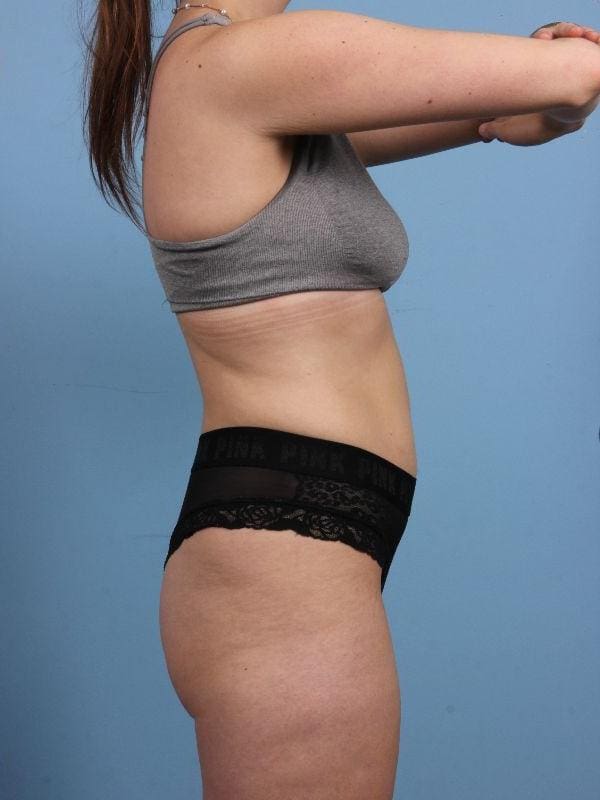 CoolSculpting Patient Photo - Case 13899 - after view-2
