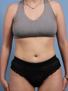 CoolSculpting - Case 13899 - After