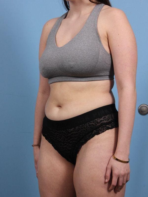 CoolSculpting Patient Photo - Case 13899 - before view-3