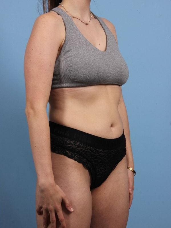 CoolSculpting Patient Photo - Case 13899 - after view-4