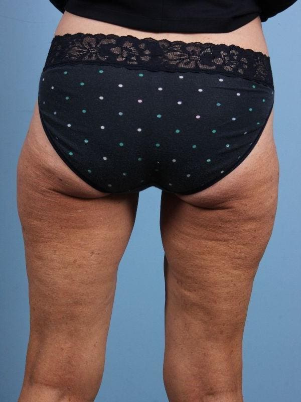 CoolSculpting Patient Photo - Case 13911 - after view-1