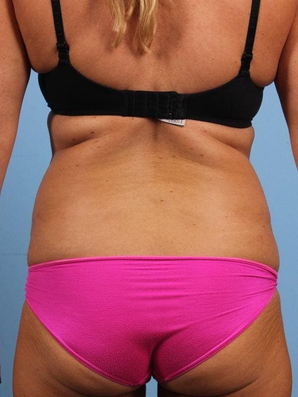 CoolSculpting Patient Photo - Case 13917 - after view-5