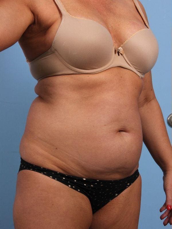 CoolSculpting Patient Photo - Case 13917 - before view-4