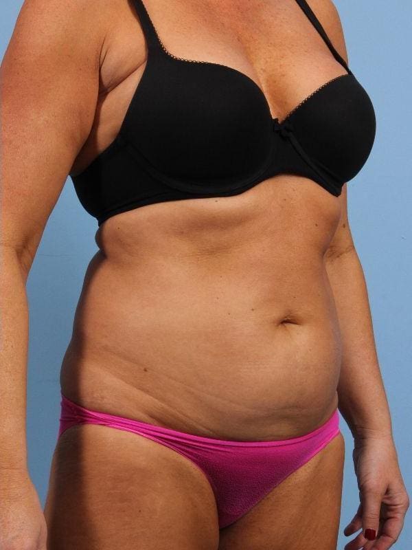 CoolSculpting Patient Photo - Case 13917 - after view-4