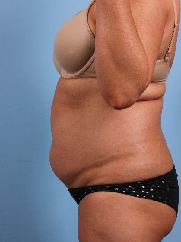 CoolSculpting Patient Photo - Case 13917 - before view-1