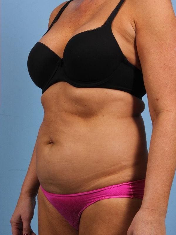 CoolSculpting Patient Photo - Case 13917 - after view-3