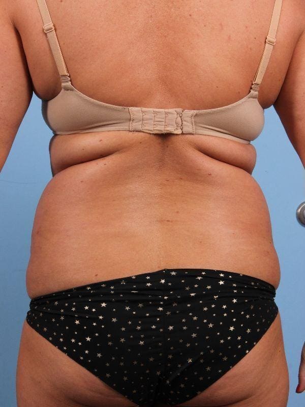 CoolSculpting Patient Photo - Case 13917 - before view-5