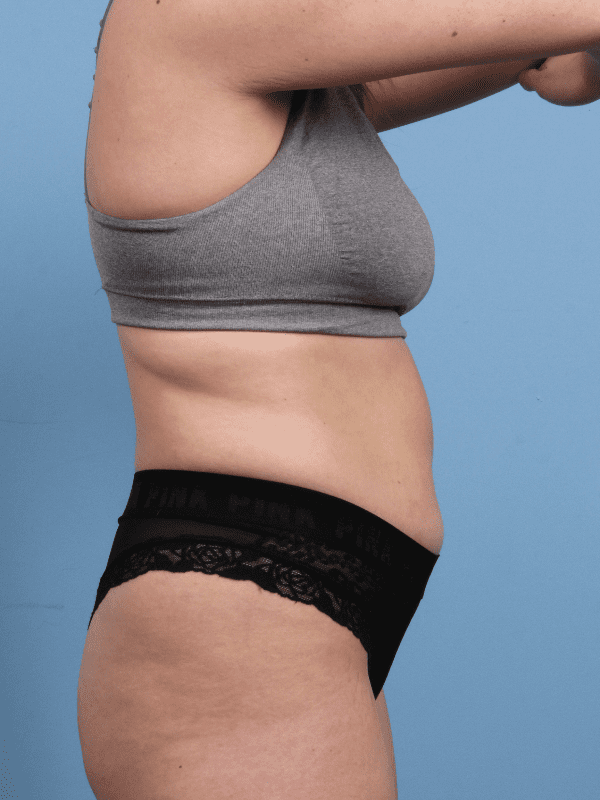 CoolSculpting Patient Photo - Case 13931 - before view-2