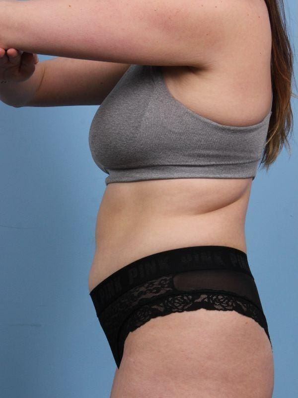 CoolSculpting Patient Photo - Case 13931 - before view-1