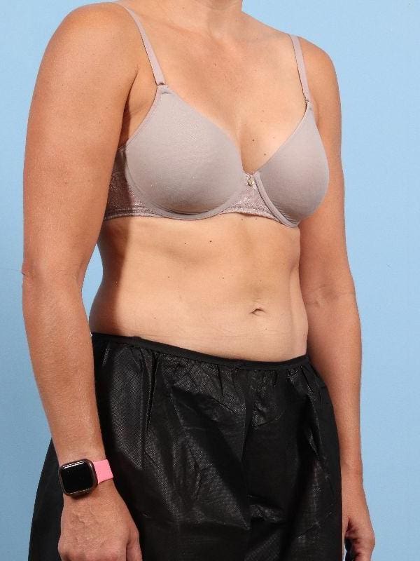 CoolSculpting Patient Photo - Case 13956 - after view-4