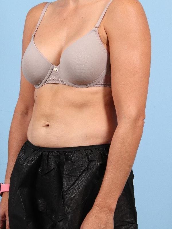 CoolSculpting Patient Photo - Case 13956 - after view-3