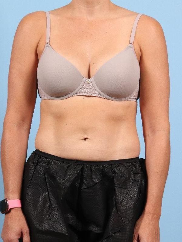 CoolSculpting Patient Photo - Case 13956 - after view