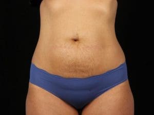 EMSCULPT - Case 13968 - After