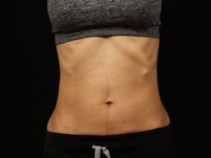 EMSCULPT - Case 13974 - Before