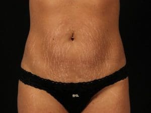 EMSCULPT - Case 13980 - After