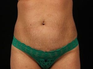 EMSCULPT - Case 13980 - Before