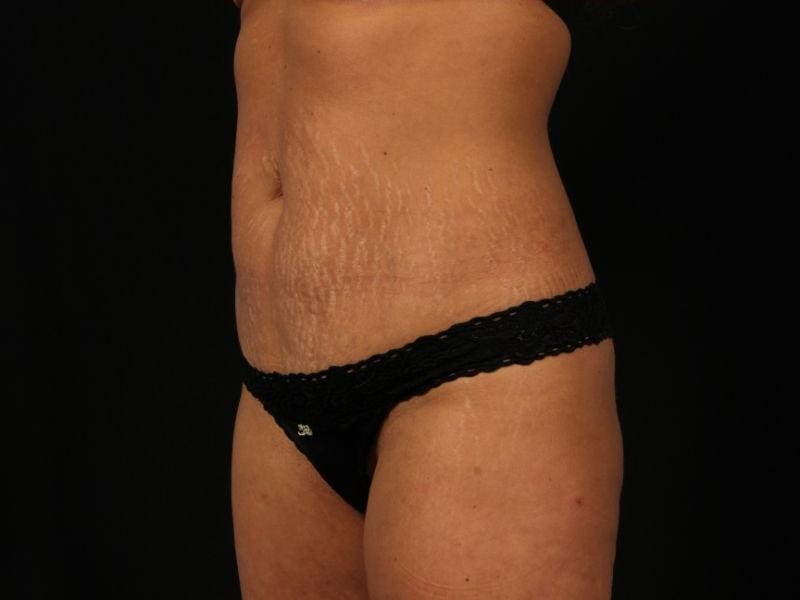 EMSCULPT Patient Photo - Case 13980 - after view-2
