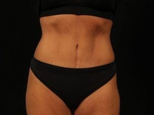EMSCULPT - Case 13988 - Before