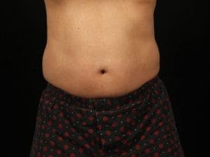 EMSCULPT - Case 13994 - Before