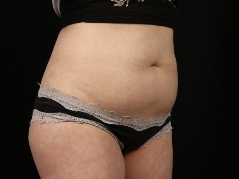 EMSCULPT Patient Photo - Case 13998 - before view-1