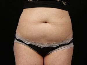 EMSCULPT - Case 13998 - Before