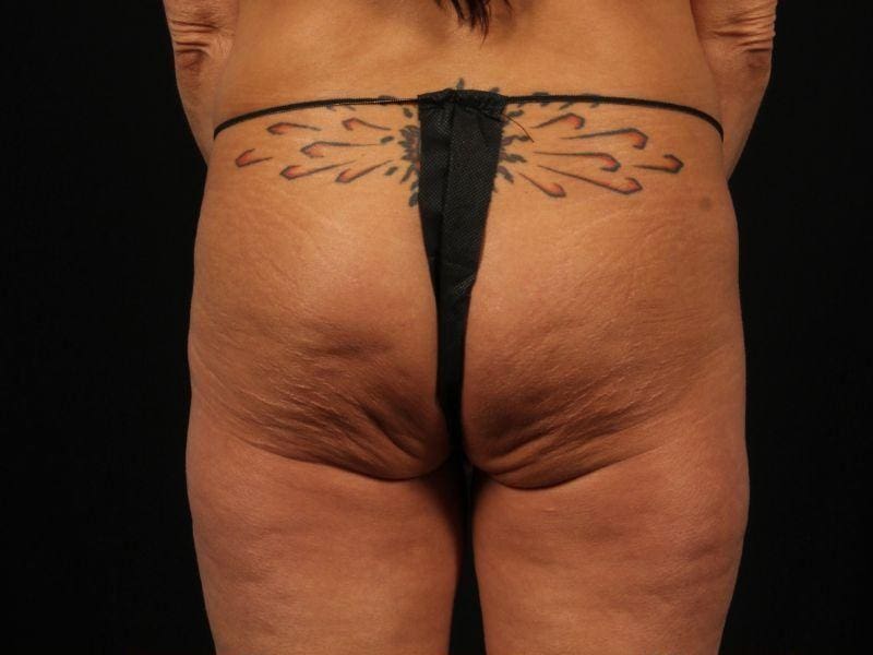 EMSCULPT Patient Photo - Case 14004 - before view-