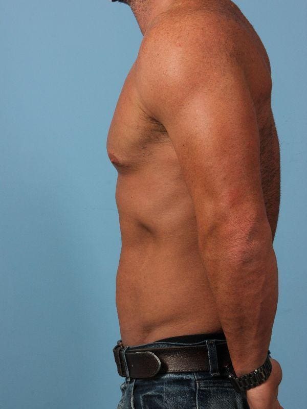 EMSCULPT Patient Photo - Case 14013 - before view-1